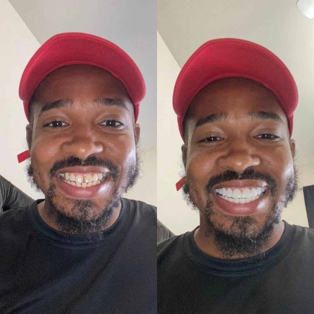 Osmilea™ Clip-on Veneers